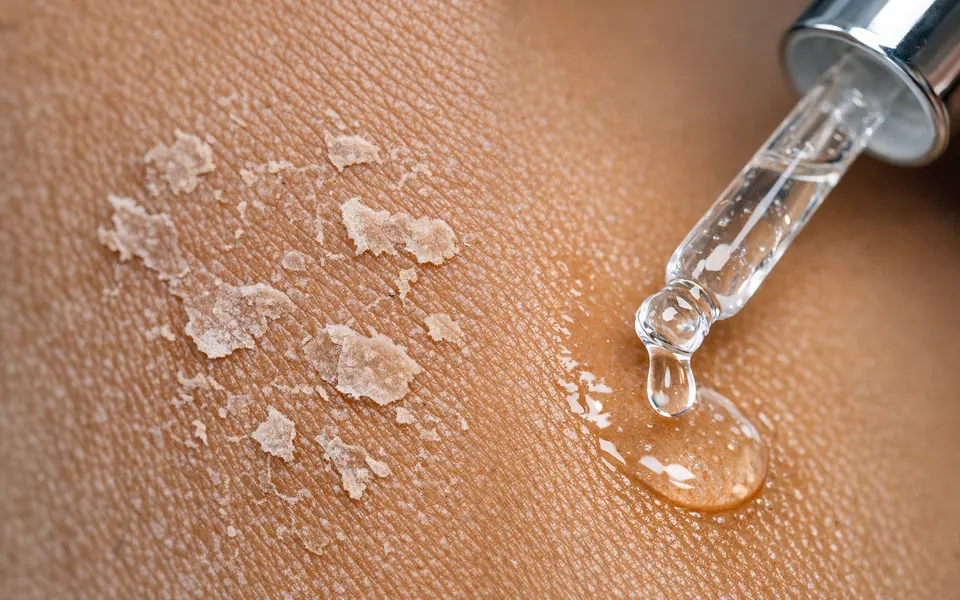 Close-up of dry, flaky patch on brown skin next to a gentle hydrating serum being applied.