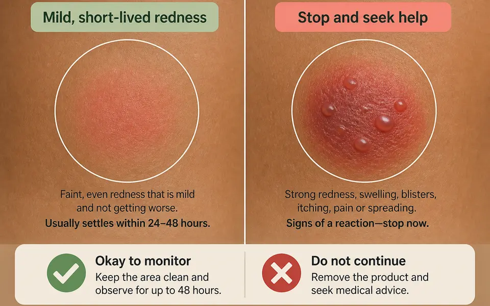 Side-by-side drawing of two small skin patches on Indian skin: one with mild, short-lived redness labelled as acceptable to monitor, and one with blisters and swelling labelled as stop and seek help.