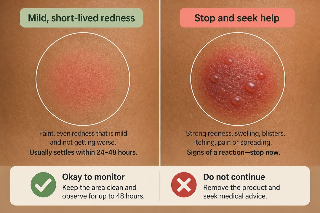 Side-by-side drawing of two small skin patches on Indian skin: one with mild, short-lived redness labelled as acceptable to monitor, and one with blisters and swelling labelled as stop and seek help.
